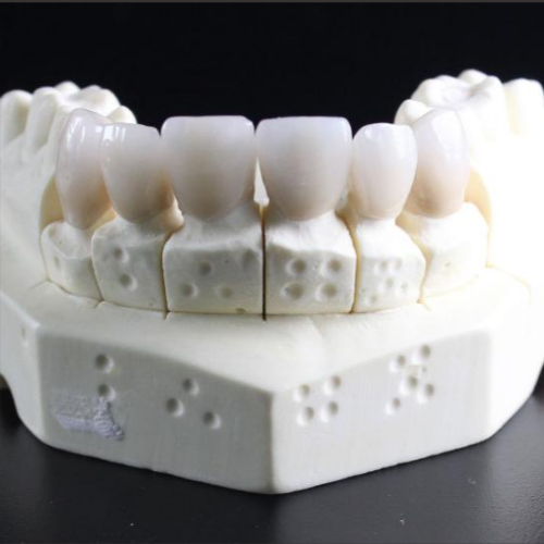 부분 틀니 모형