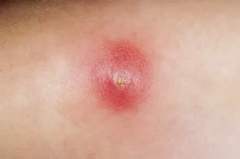 엉덩이 종기가 생기는 이유 왜 생기고 어떻게 관리할까요 완벽 가이드_23