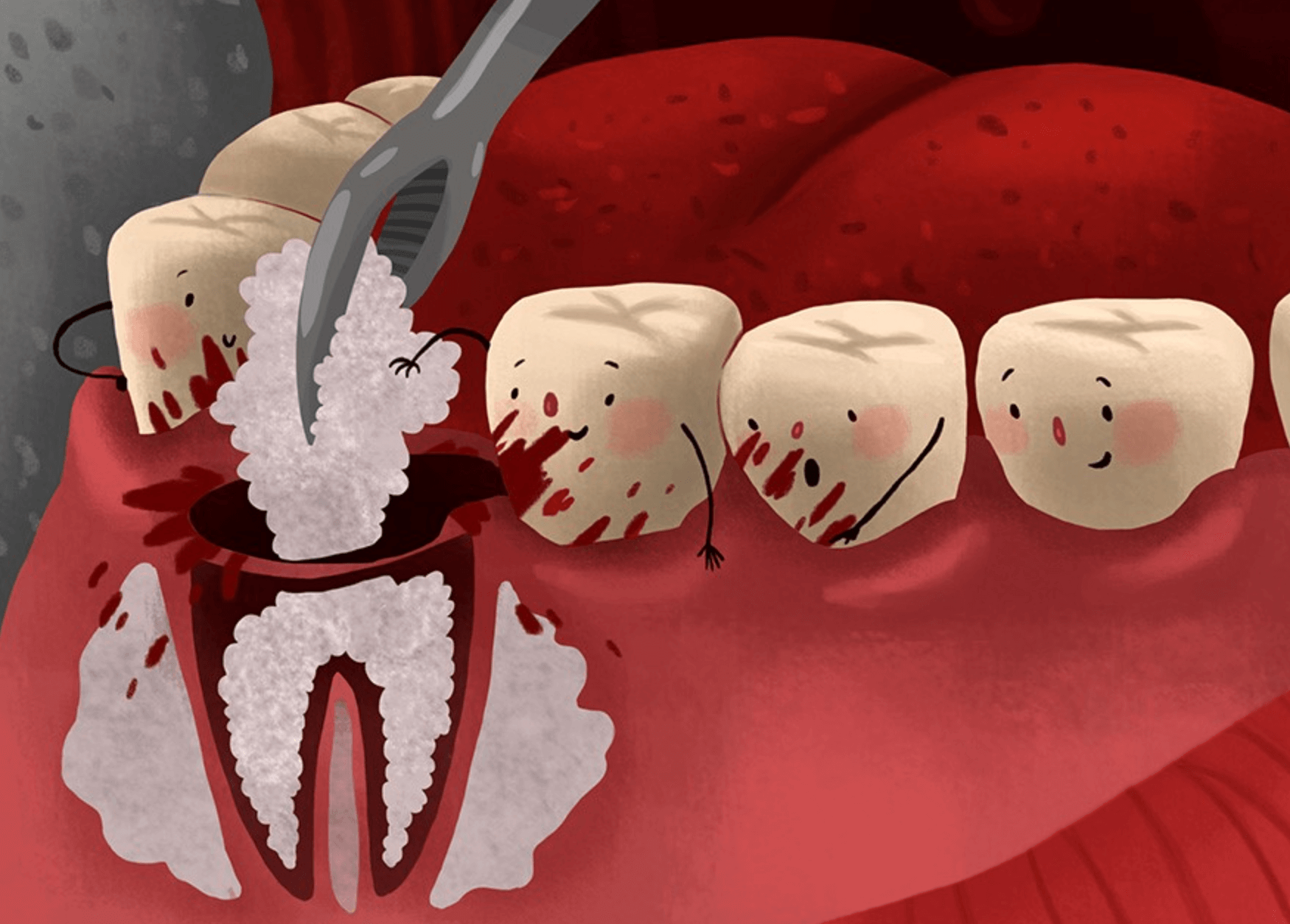 임플란트 뼈이식