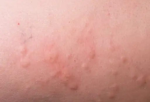 두드러기 원인 및 치료방법