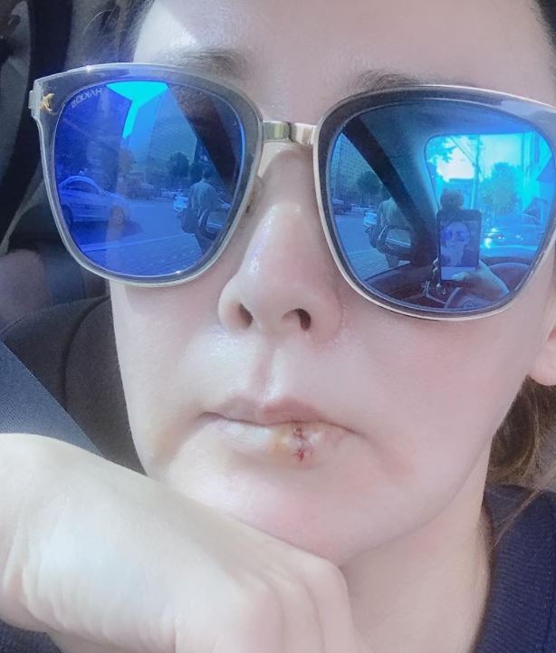 이상아 입술필러