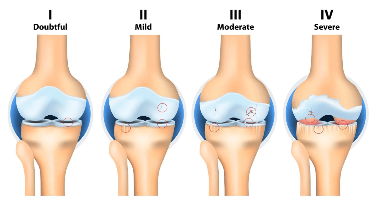 무릎 관절 상태 단계