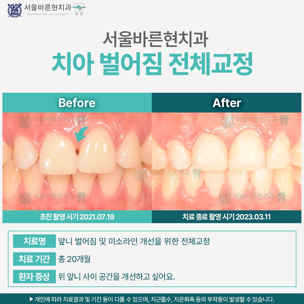 부산치아교정
