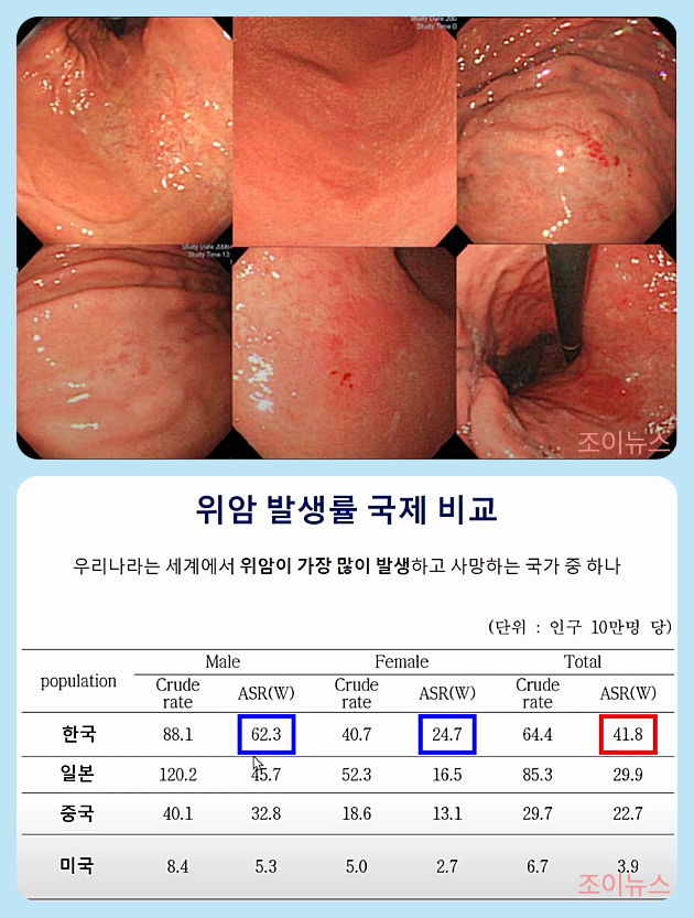 조기 위암의 모습(위)/ 위암 발생률 국제 비교(아래)
