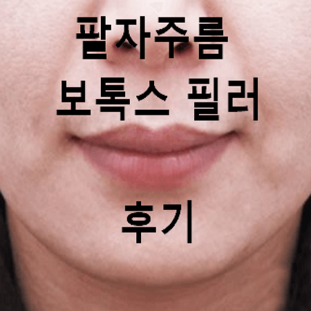 팔자주름-심한-여성