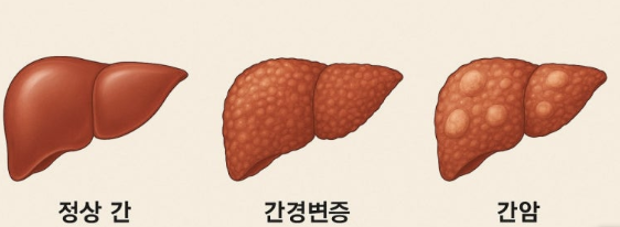 간암치료