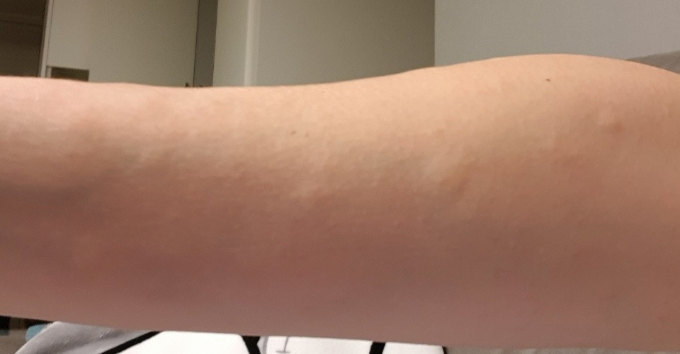 팔에 발진이 생긴 모습 사진