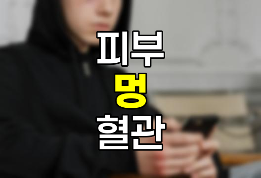 자주 멍이 드는 이유와 효과적인 대처 방법