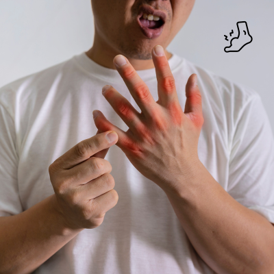 통풍의 원인과 시기별 증상, 예방