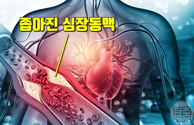 가슴통증 원인 증상 의심되는병 협심증