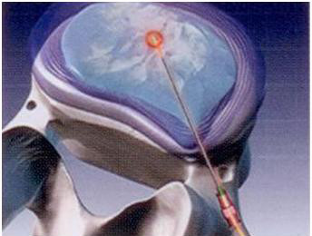 목디스크 치료방법