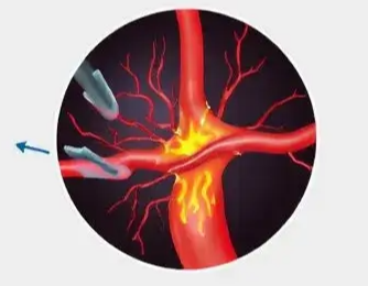 모야모야병, 모야모야병 원인, 모야모야병 증상, 모야모야병 유전, 뇌출혈 모야모야, 모야모야병 수술, 뇌졸중