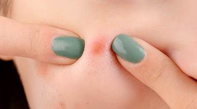 종기가 생기는 이유