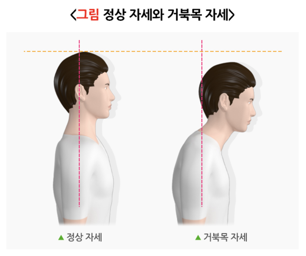 정상 자세와 거북목 자세