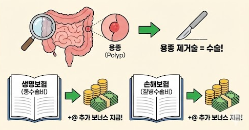 수면내시경 용종 제거 실비보험