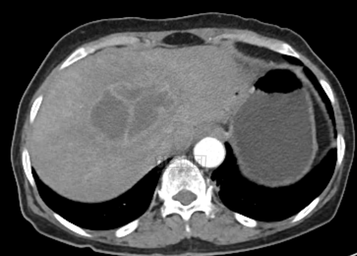 AST ALT 수치 상승