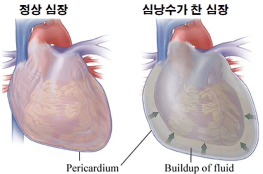 심낭질환