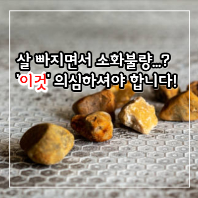담석 증상 및 제거 수술과 좋은 음식