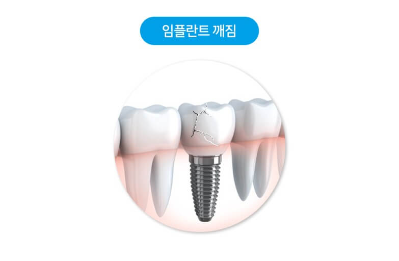 임플란트 보험 임플란트 가격 임플란트 비용 치아 보험 추천 치과 보험 추천 임플란트 치아 보험 치아 보험 적용 기과 보험 적용 치과 보험 임플란트 임플란트 치아
