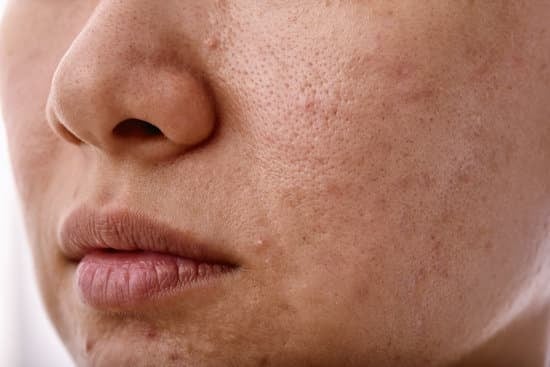 [여드름 색소 침착 없애는 법] 붉은 자국과 갈색 자국, 어떻게 다를까?