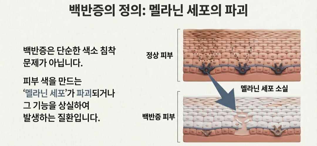 백반증원인-사진10