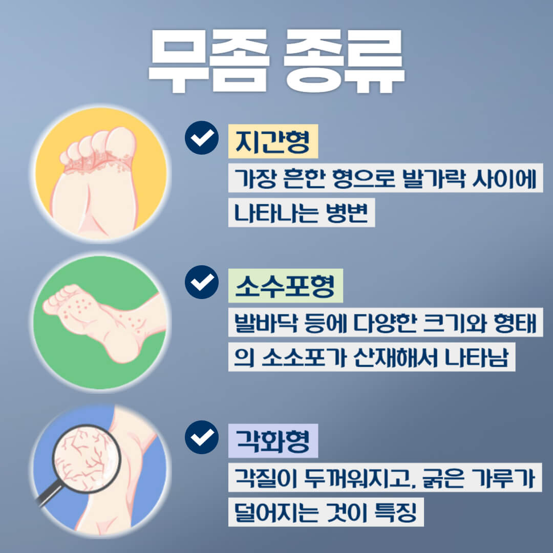 무좀 종류