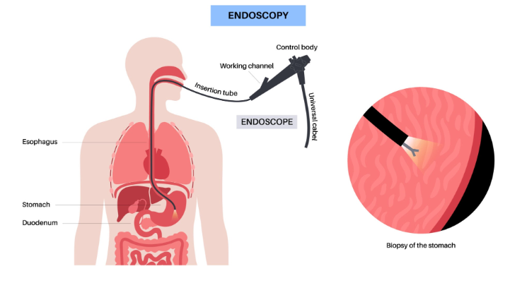 위내시경 조직검사 하는이유