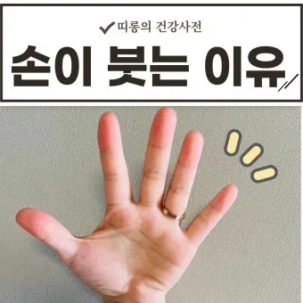 손등 붓는 이유 혈액순환 문제 증상과 해결법 정리_22