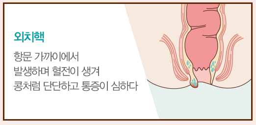 치질자가치료