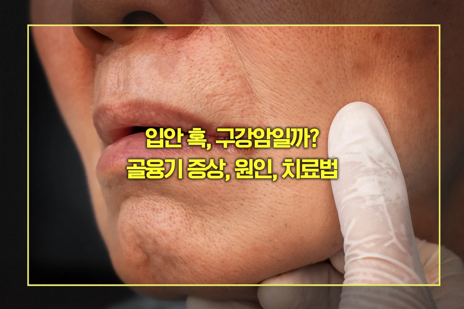 구강암으로 오해받는 골융기 증상, 원인, 치료법