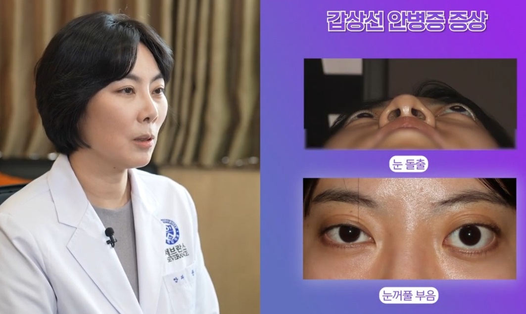 EBS명의-안검하수-안성형-성형안과-윤진숙-교수