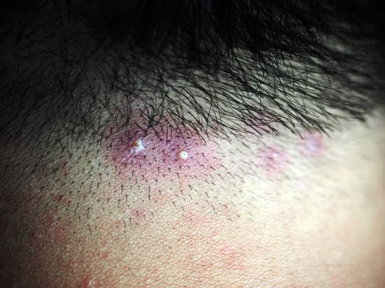 모낭염 (Folliculitis) – 모공 감염성 염증