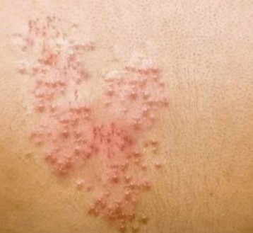 대상포진 치료방법