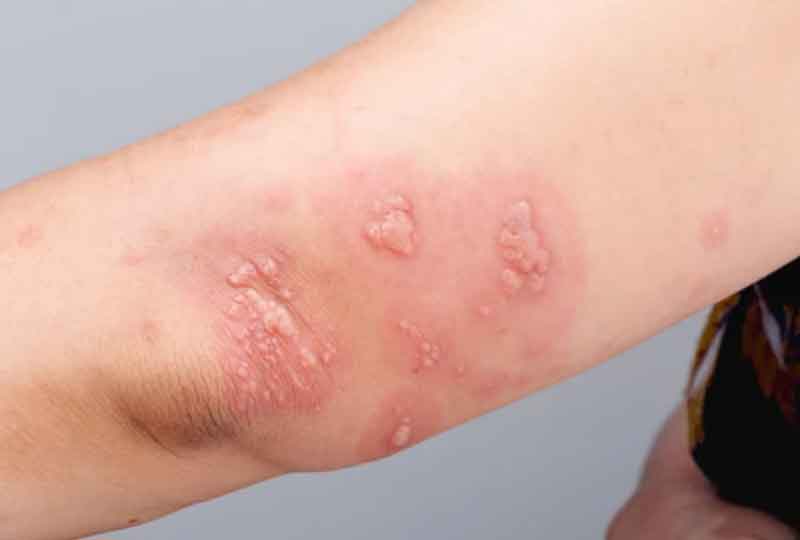 대상포진의 증상 원인 예방법 예방접종 치료법