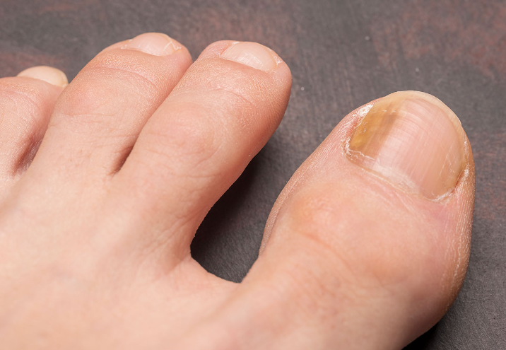 발톱무좀 없애는 방법, 치료 섬네일