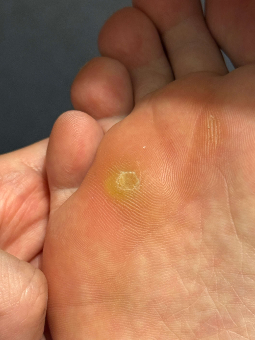 족저사마귀-발바닥-사진