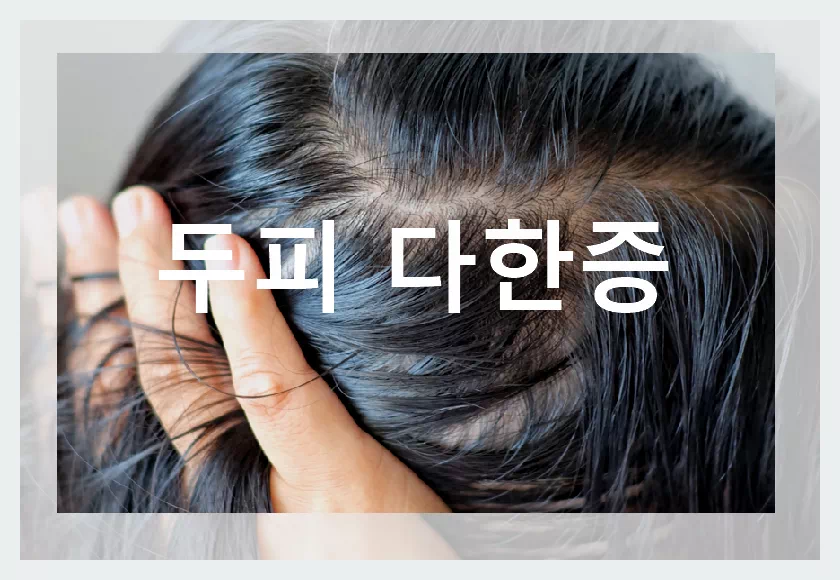 두피다한증