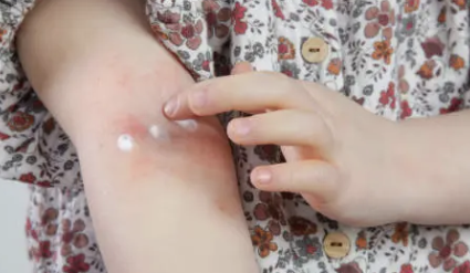 수족구 증상 30