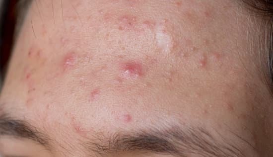 벤조일 퍼옥사이드(Benzoyl Peroxide): 여드름 치료의 대표 성분