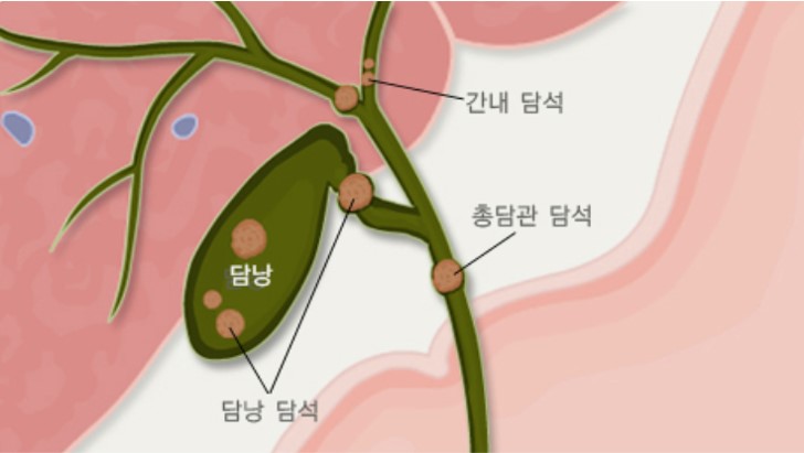 담석증