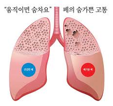 폐에 물이 차는 원인