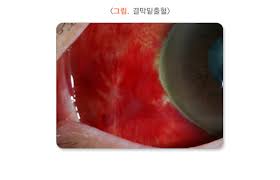 눈 실핏줄이 터지는 이유