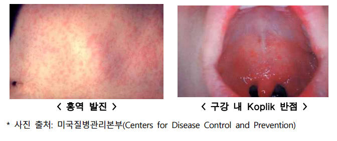 베트남 여행 전 홍역 증상·예방접종 비용·병원 정보