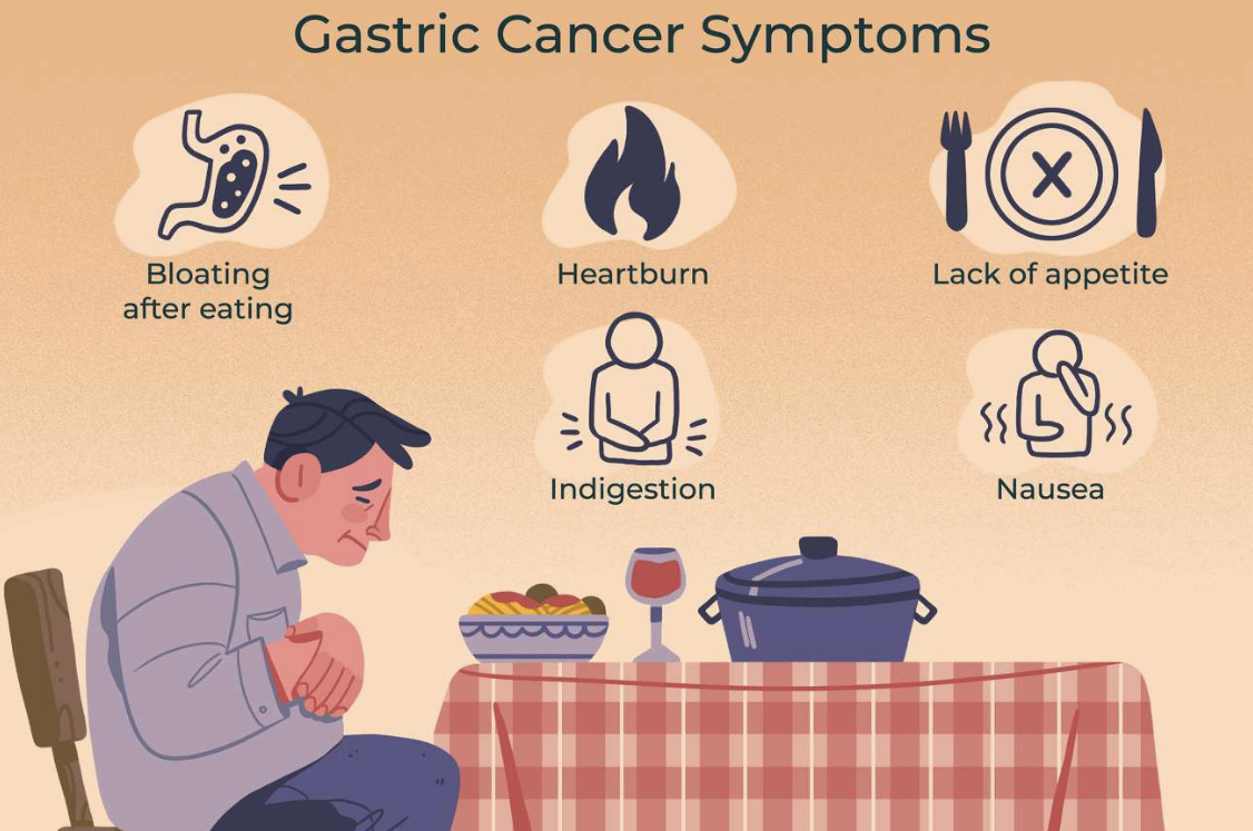 위암 초기증상 1
