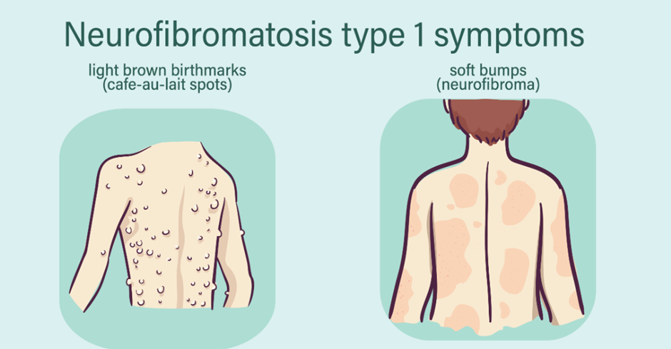 신경섬유종증이 있는 환자 등에 있는 종양과 반점