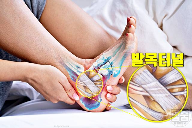 발뒤꿈치 찌릿 따끔 발바닥 전기 통증 발목터널증후군