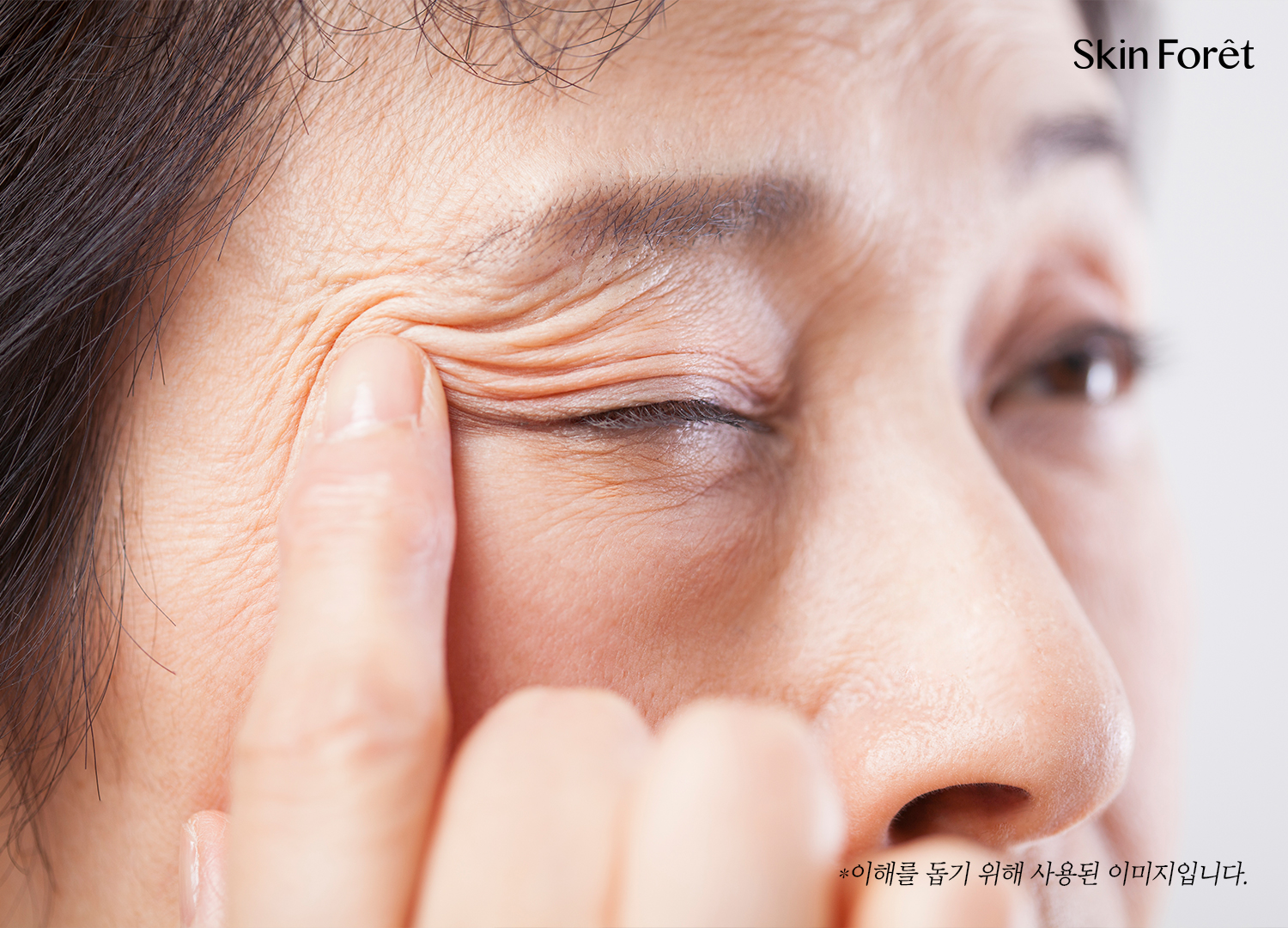 처진 눈꺼풀 수술 전후, 상안검과 쌍꺼풀 흉터