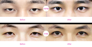 여자 무쌍 눈매 교정