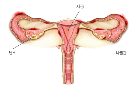 장궁내막증