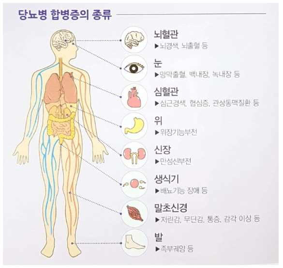 당뇨병 합병증의 종류